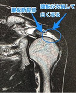 腱 板 断裂