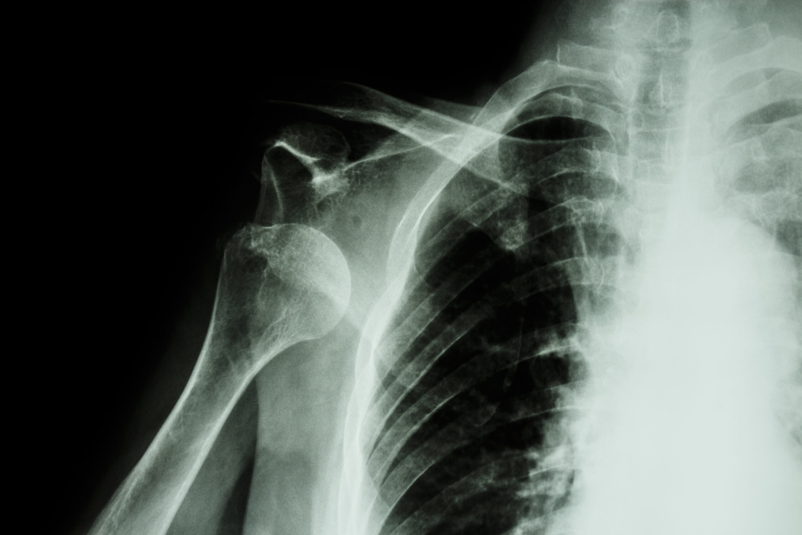 肩の脱臼における手術とリハビリをわかりやすく解説 | 医療法人社団景